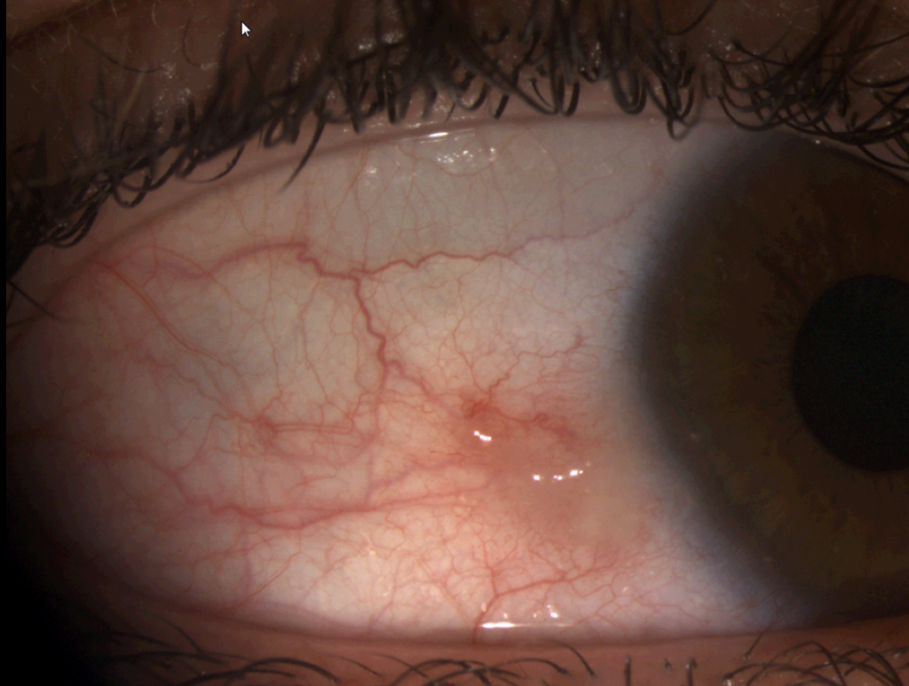 13 yr old boy with pinguecluae