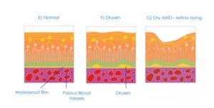 Diagram showing dry macular degeneration with drusen deposits under the retina and gradual thinning of the macula