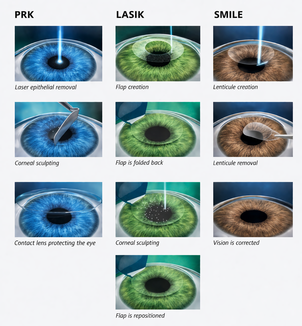 Laser Vision Correction Sydney | SMILE vs LASIK vs PRK Explained Laser vision correction procedures including SMILE, LASIK and PRK shown in a step by step comparison of corneal reshaping techniques.