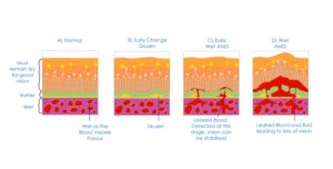 Diagram showing types of age-related macular degeneration including normal retina, drusen formation, early wet AMD and advanced wet AMD with choroidal neovascularisation and bleeding.