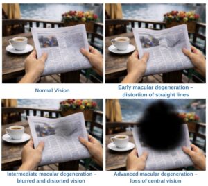 Four images showing vision changes in age-related macular degeneration: normal vision, early distortion of straight lines, mid stage blurred and distorted vision, and late stage central vision loss with a dark patch.