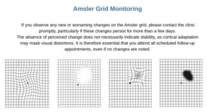 Amsler grid examples showing normal grid, distorted lines, blurred area and dark spot which may occur with macular degeneration.