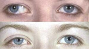 Before and after example of eye alignment in adult strabismus treated with botulinum toxin (Botox) injection.