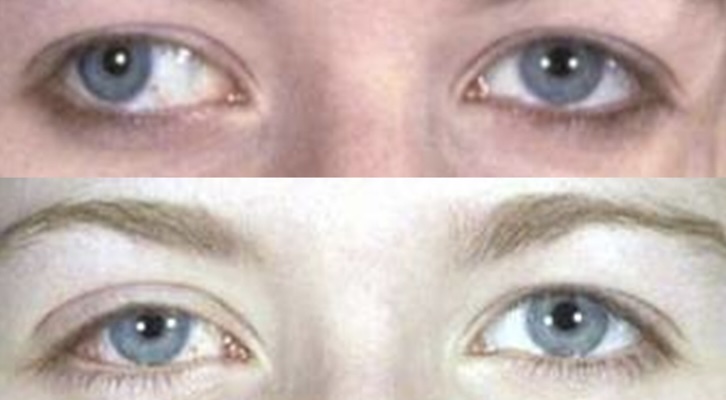 Before and after example of eye alignment in adult strabismus treated with botulinum toxin (Botox) injection.