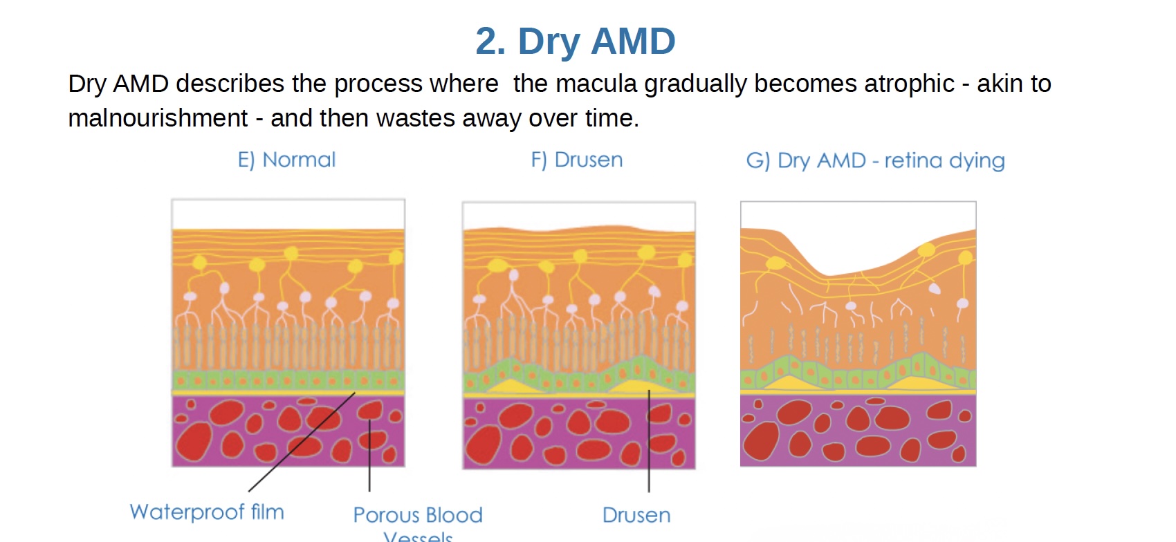Diagram showing dry macular degeneration with drusen deposits under the retina and gradual thinning of the macula