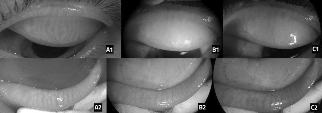 Meibomian gland imaging showing meibomian glands on the tarsal surface of the lid using tear check at Eye & Laser Surgeons Sydney
