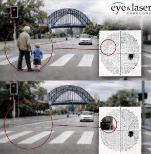 Glaucoma vision loss illustration showing reduced peripheral vision and visual field test results in Sydney