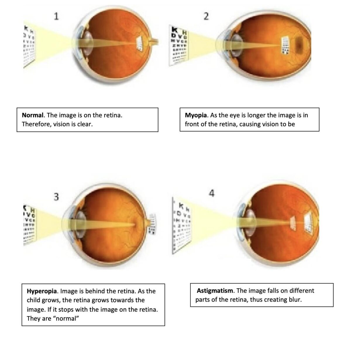 Diagram showing how light focuses in a normal eye and how myopia, hyperopia and astigmatism change the focal point on or around the retina. This is what laser vision correction adjusts.