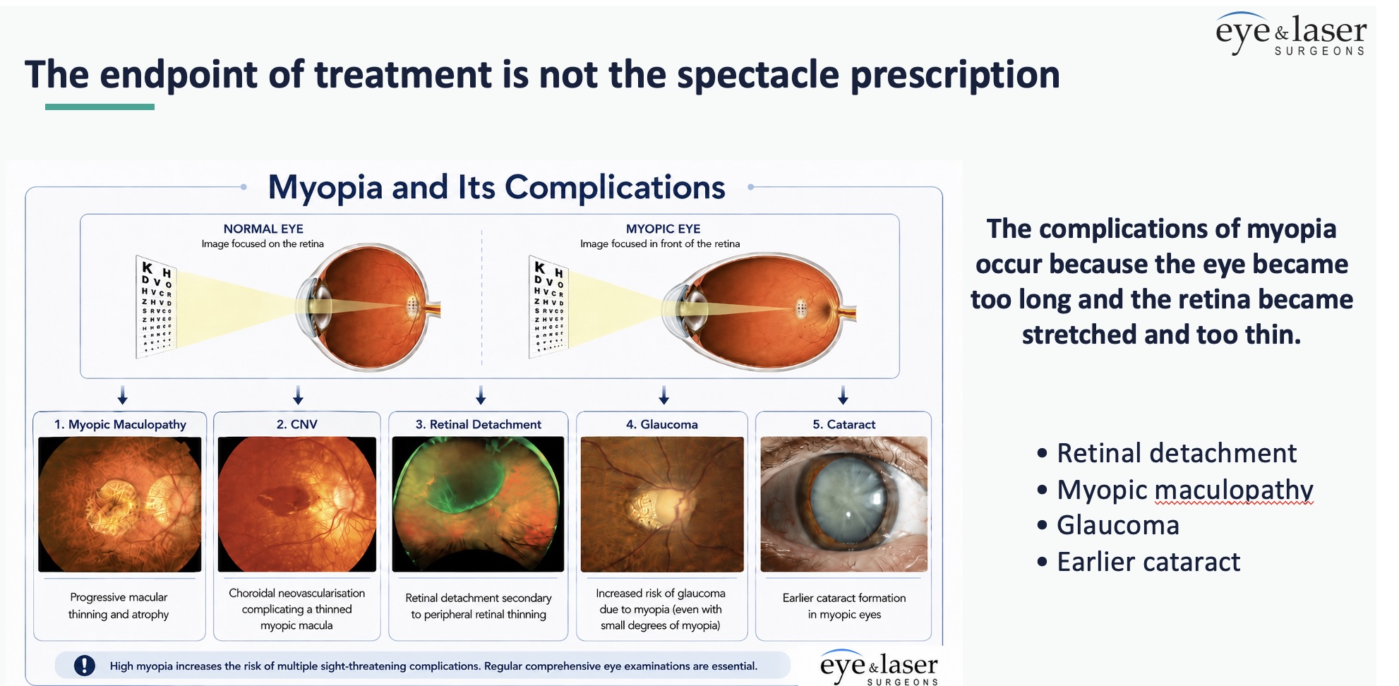 Diagram comparing a normal and elongated myopic eye with retinal stretching and long-term complications of myopia